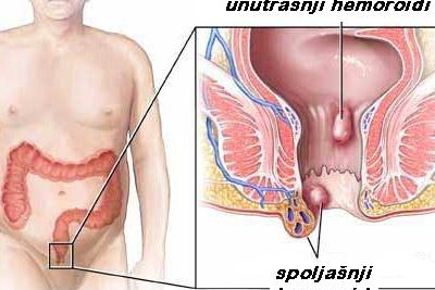 Anoskopija sa sklerozacijom hemoroida