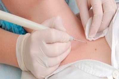 Uklanjanje fibroma radiotalasnom metodom